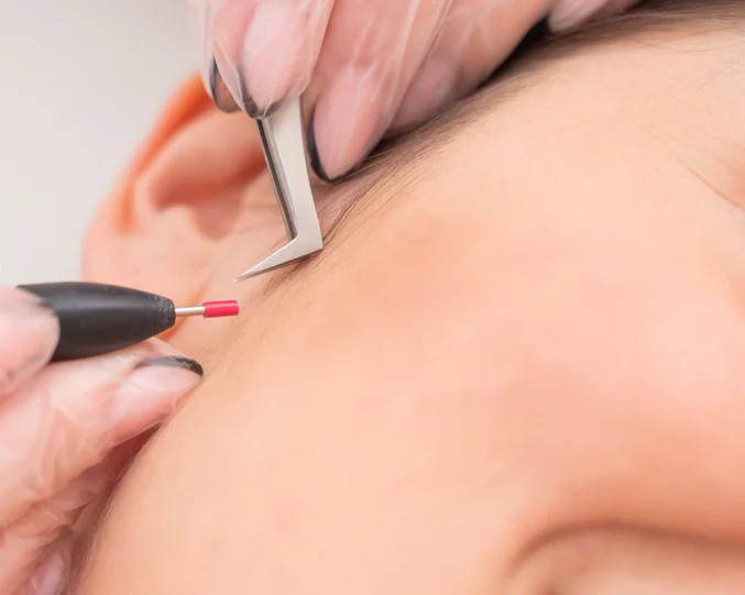Electrolysis Service at Alpha Med Spa Clinic Brampton for precise and permanent facial hair removal