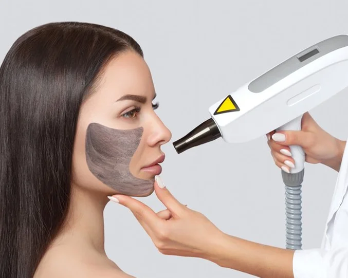 Hollywood Laser Peel Service at Alpha Med Spa Clinic Brampton for skin brightening and smooth complexion
