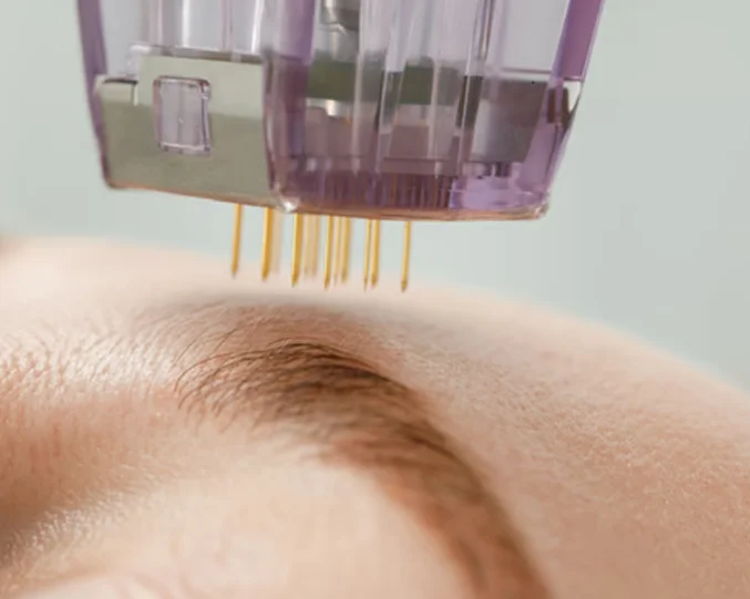 Radio Frequency Microneedling Service at Alpha Med Spa Clinic Brampton targeting skin rejuvenation and collagen stimulation