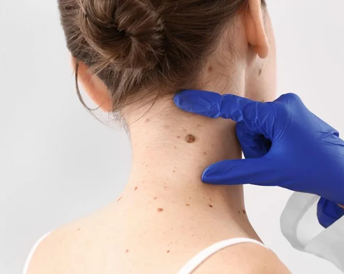 Skin Tag Removal Service at Alpha Med Spa Clinic Brampton for safe and precise skin lesion treatment