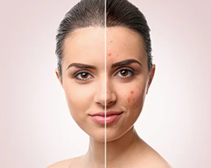 Before and after acne improvement with Treatment Facials Service at Alpha Med Spa Clinic Brampton