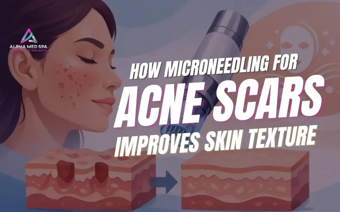 How Microneedling for Acne Scars Improves Skin Texture